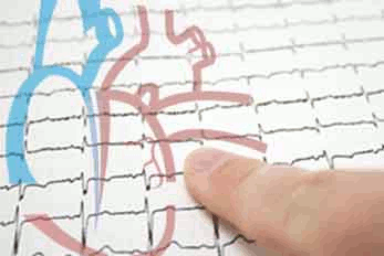 Dexmedetomidine for intubation response in offpump CABG