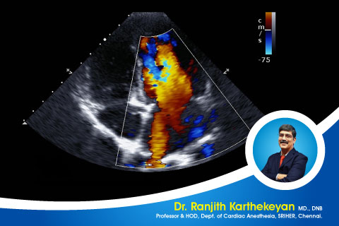 Interpretation of Echo report