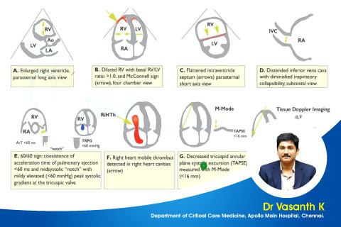 Acute Pulmonary Embolism
