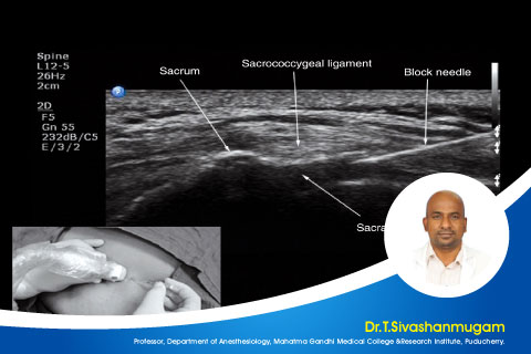 USG assisted Thoracic epidural