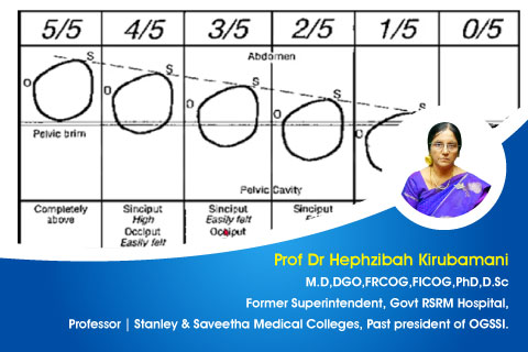 Cephalo Pelvic Disproportion