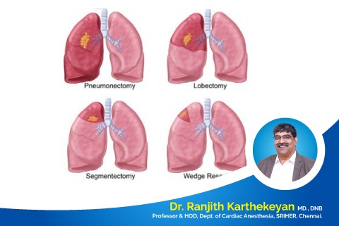 Anesthesia for thoracic surgery
